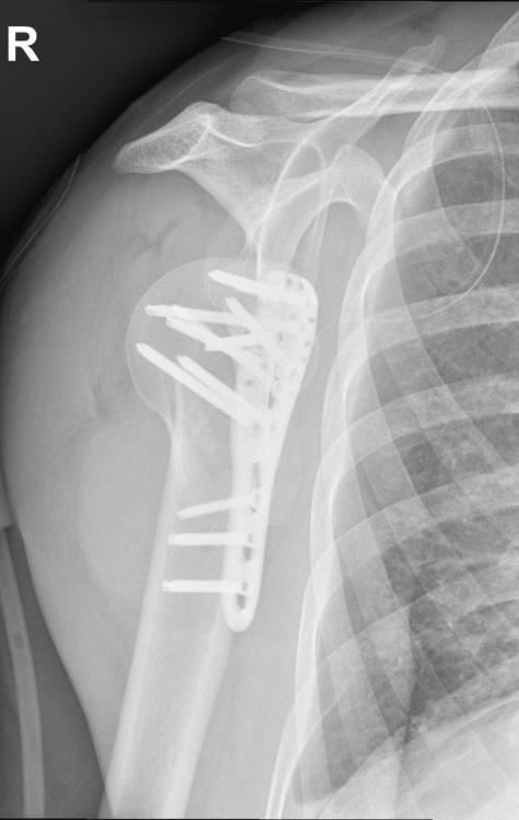M.B. Seq.8 W SCHULTER Y-AUFNAHME A.P_.jpg