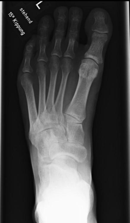 Röntgen Linker Fuß stehend mit 15 Grad Kippung.jpg