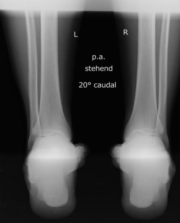 Röntgen beidseits stehend Achsstellung.jpg