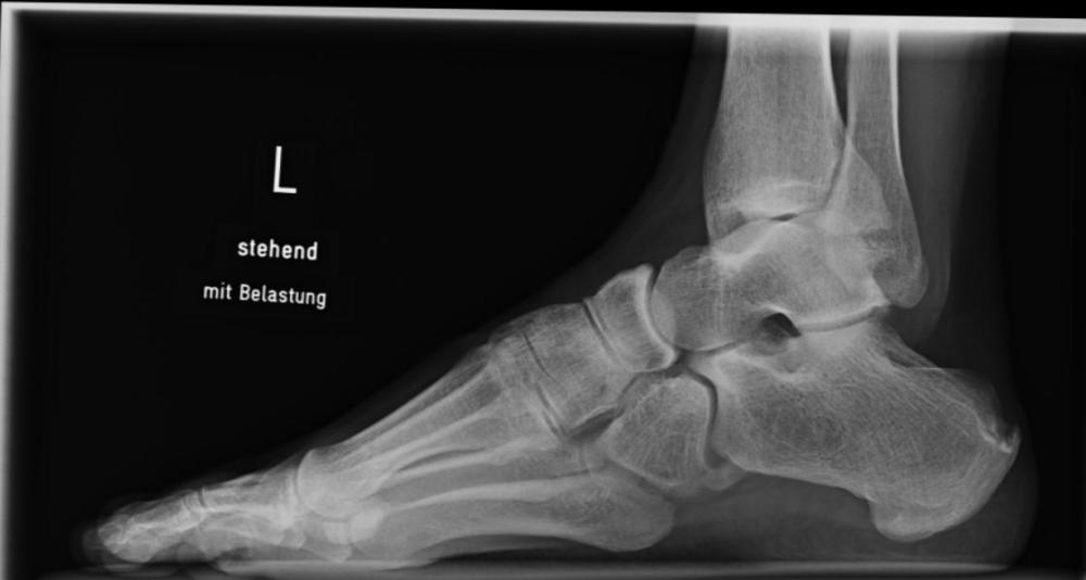 Röntgen Linker Fuß stehend mit Belastung.jpg