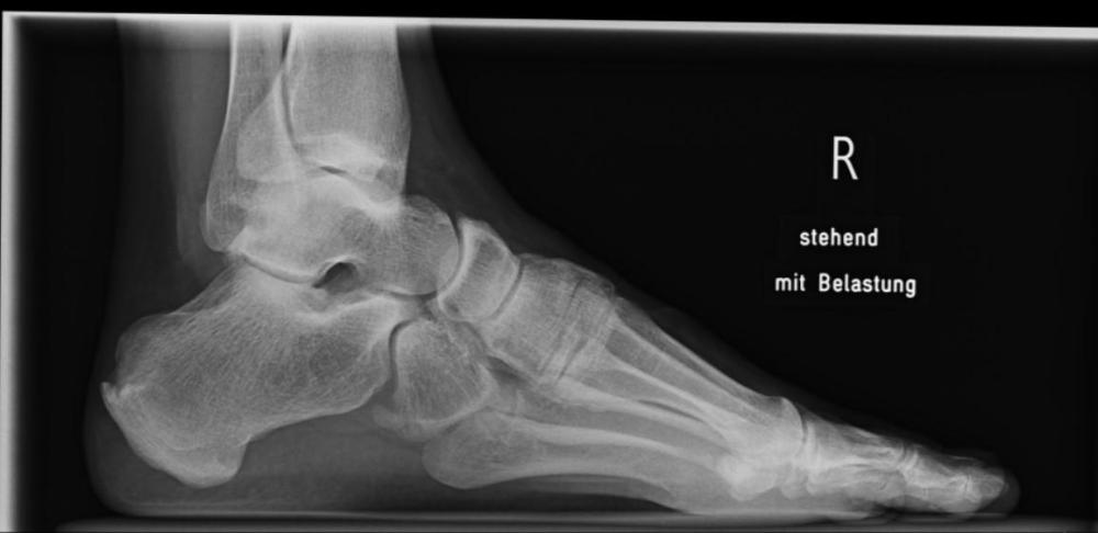 Rötngen Rechter Fuß stehend mit Belastung.jpg