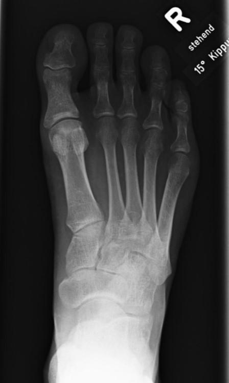 Röntgen Rechter Fuß stehend mit 15 Grad Kippung.jpg
