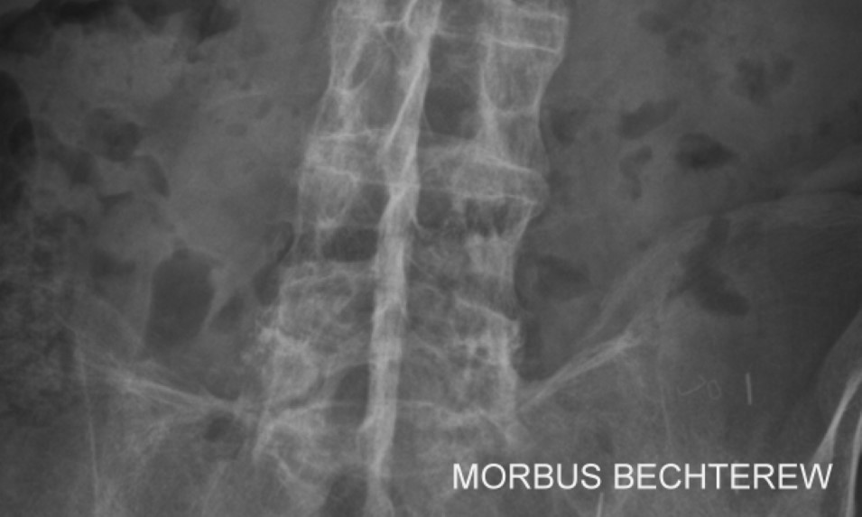 Mehr Informationen zu "Morbus Bechterew mit Physiotherapie lindern"